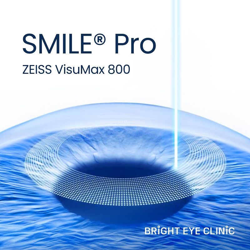 SMILE Lasik